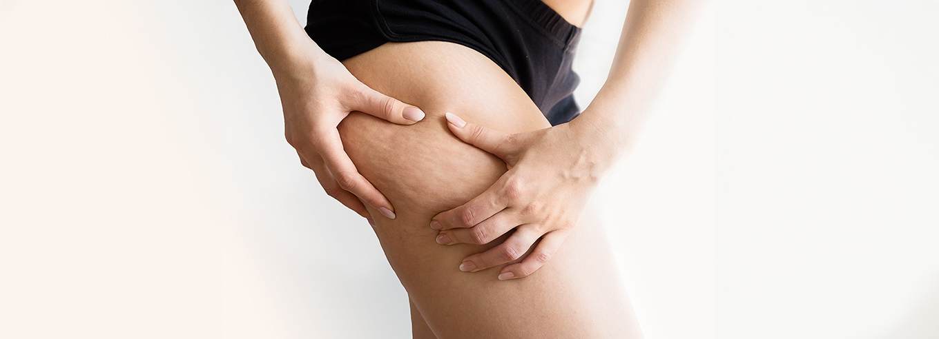 Cellulite: cause e trattamenti - Pavaglione Integratori